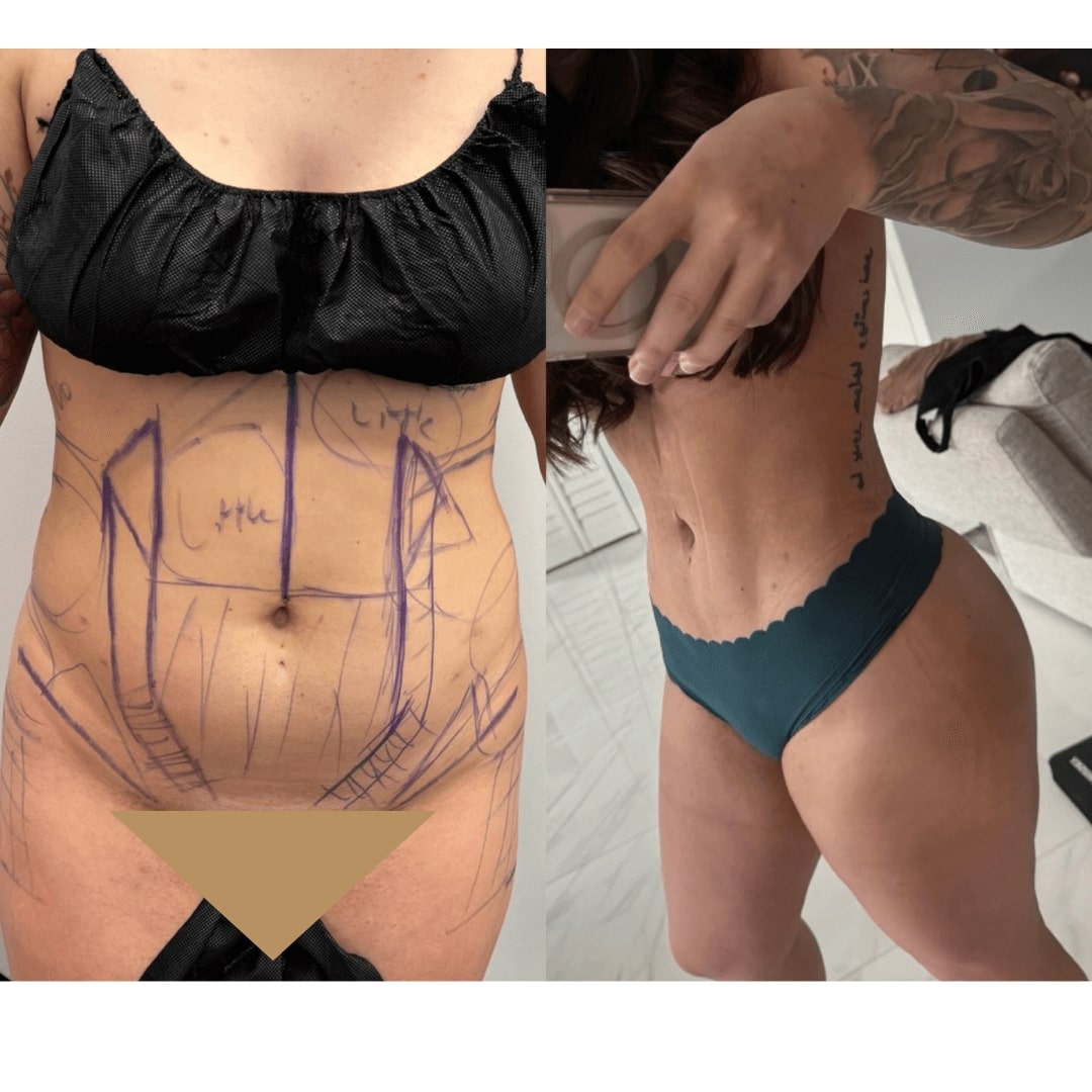 Liposuction and Fat Transfer Before & After Image