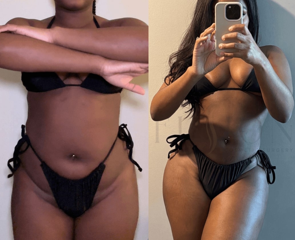 Liposuction and Fat Transfer Before & After Image