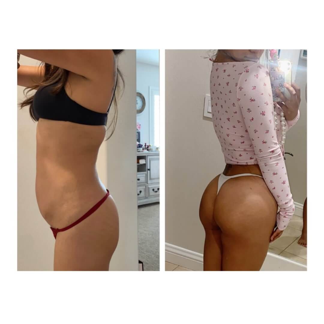 Liposuction and Fat Transfer Before & After Image