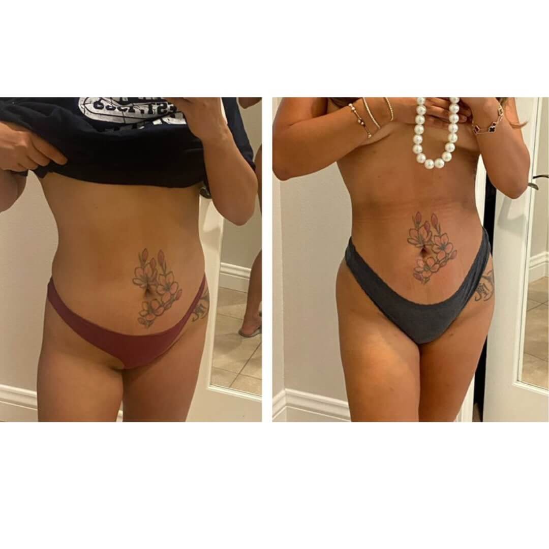 Liposuction and Fat Transfer Before & After Image