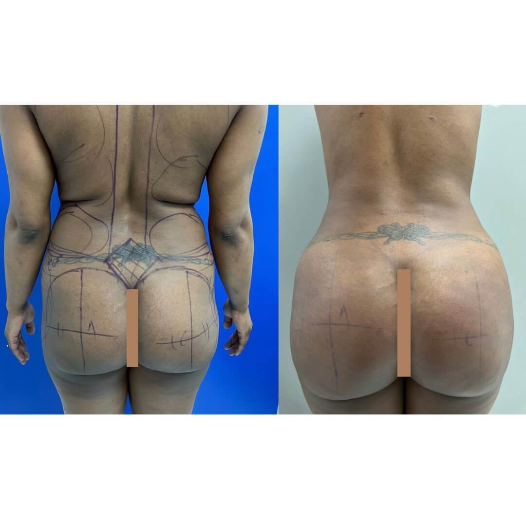 Liposuction and Fat Transfer Before & After Image