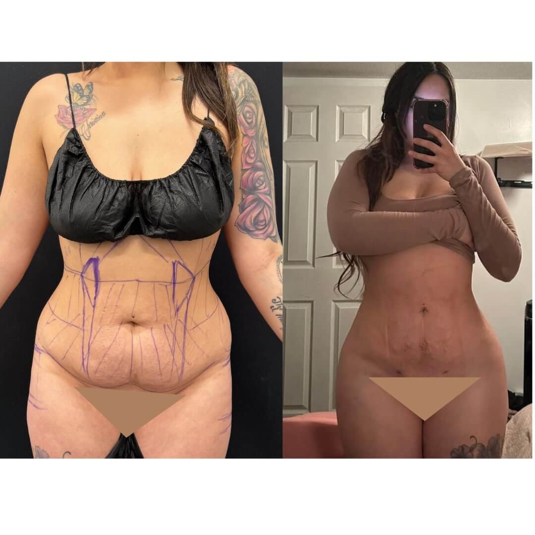 Liposuction and Fat Transfer Before & After Image