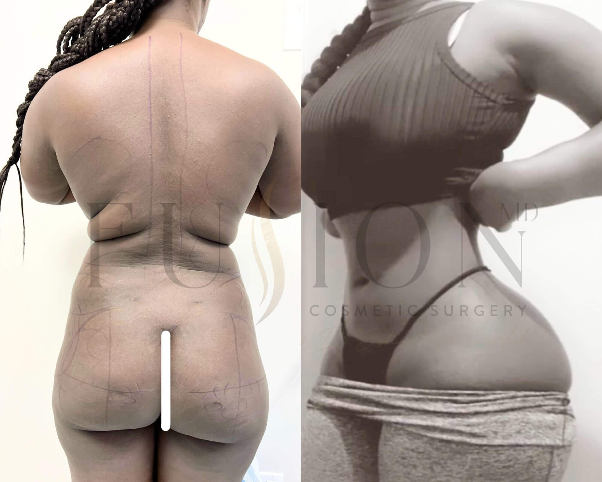 Liposuction and Fat Transfer Before & After Image