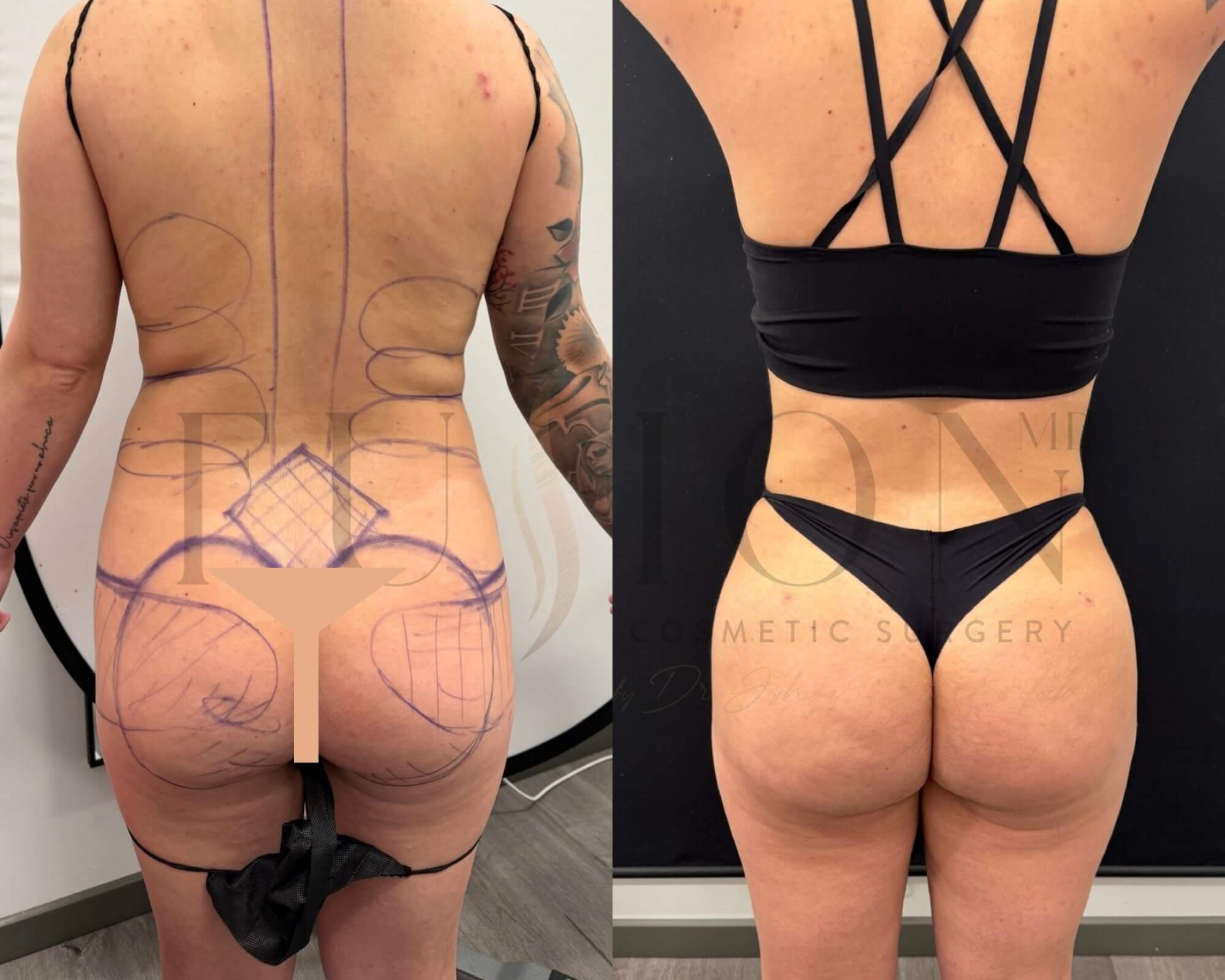 Liposuction and Fat Transfer Before & After Image
