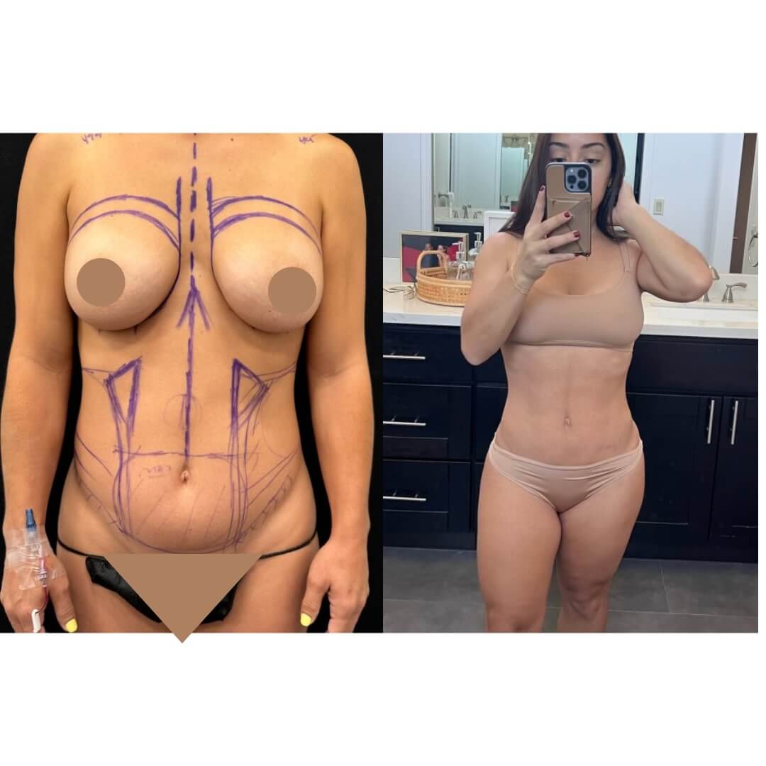 Liposuction and Fat Transfer Before & After Image