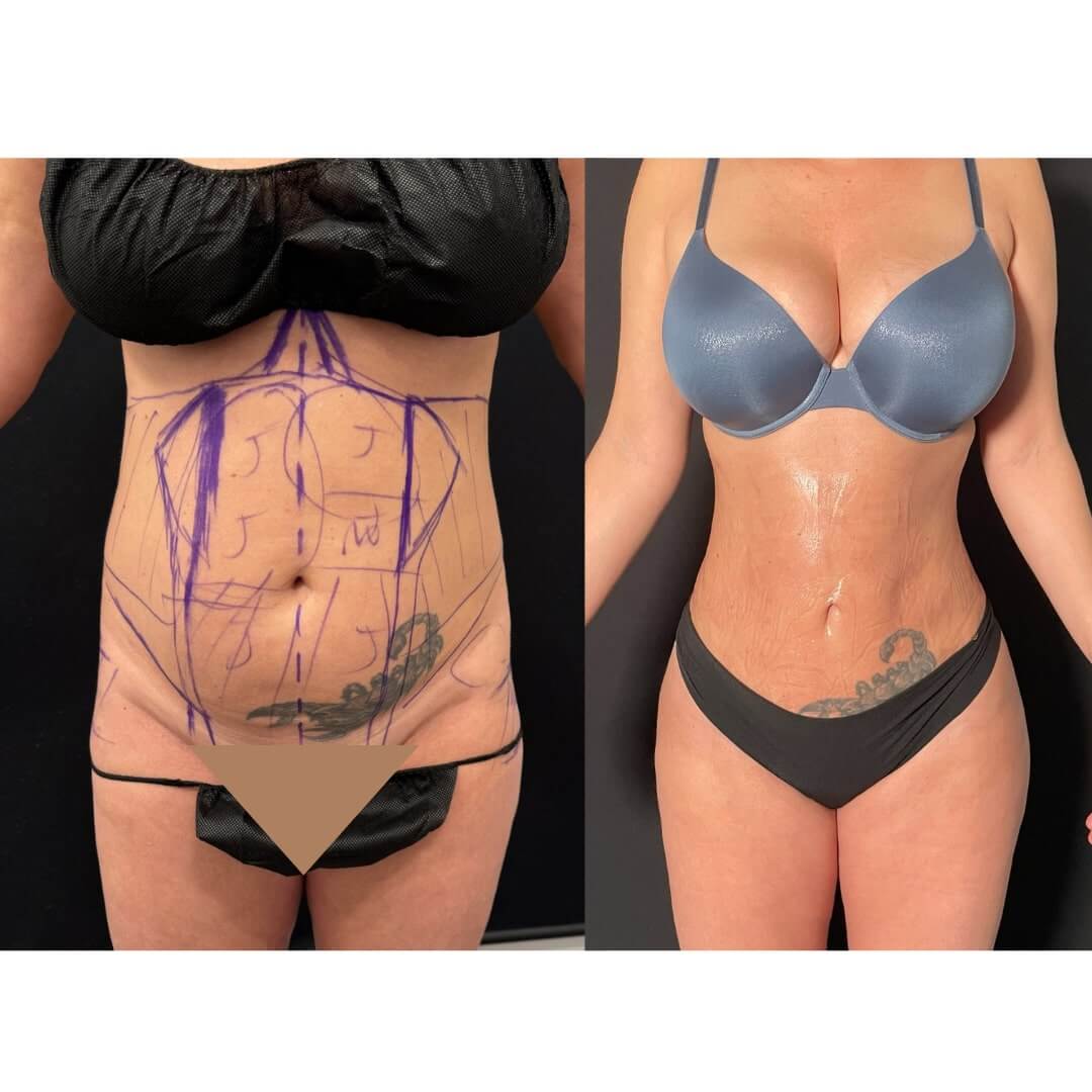 Liposuction and Fat Transfer Before & After Image