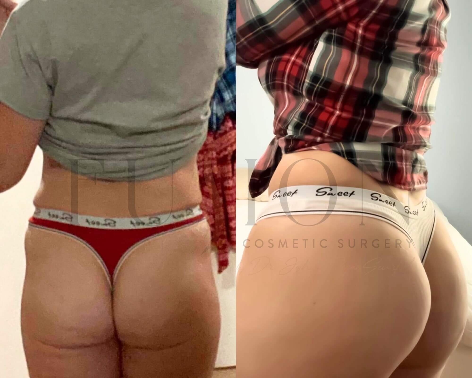 Liposuction and Fat Transfer Before & After Image