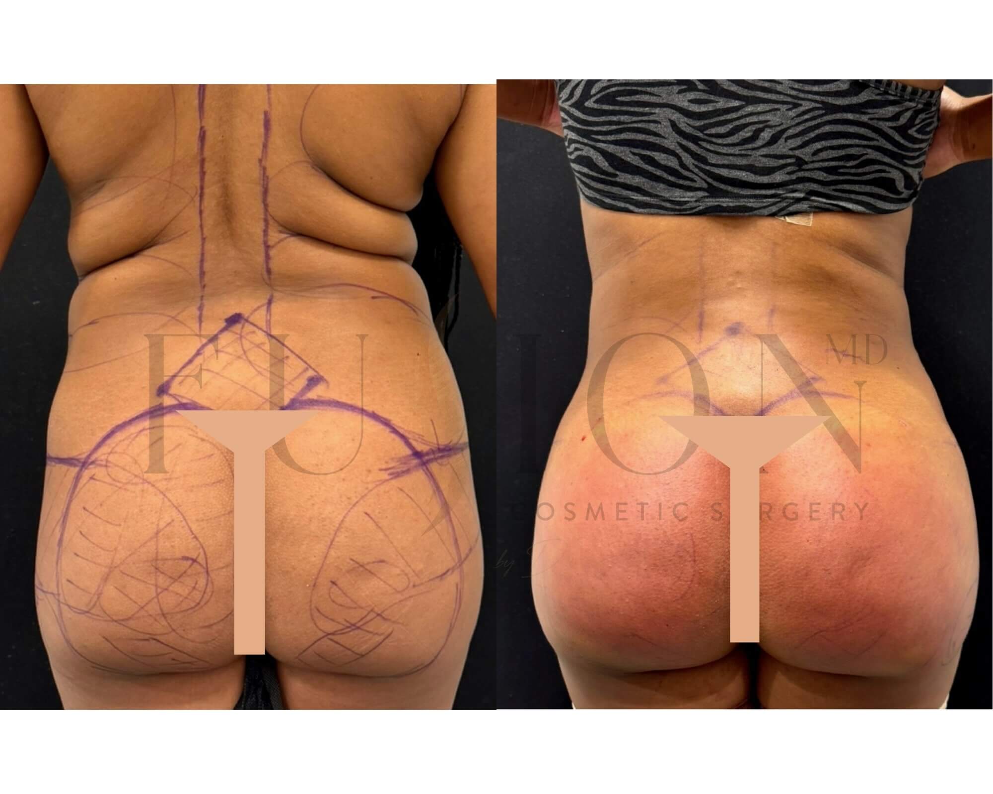 Liposuction and Fat Transfer Before & After Image