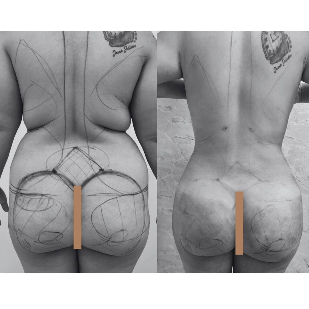Liposuction and Fat Transfer Before & After Image