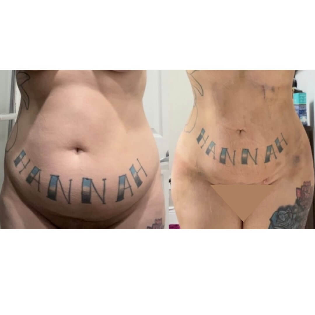 Liposuction and Fat Transfer Before & After Image