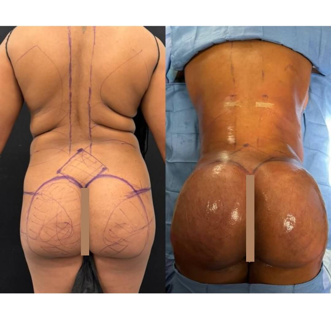 Liposuction and Fat Transfer Before & After Image