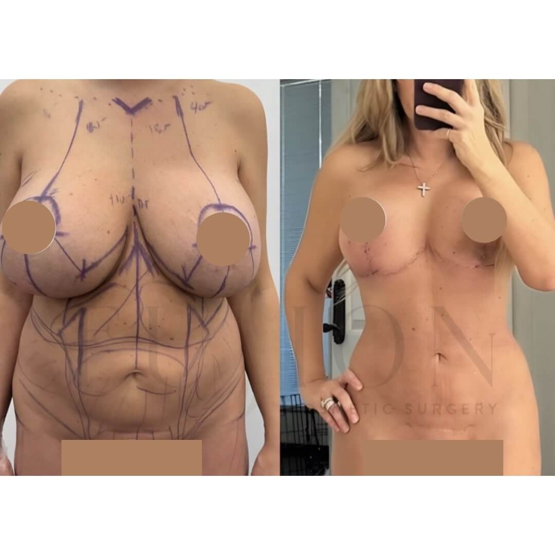 Liposuction and Fat Transfer Before & After Image
