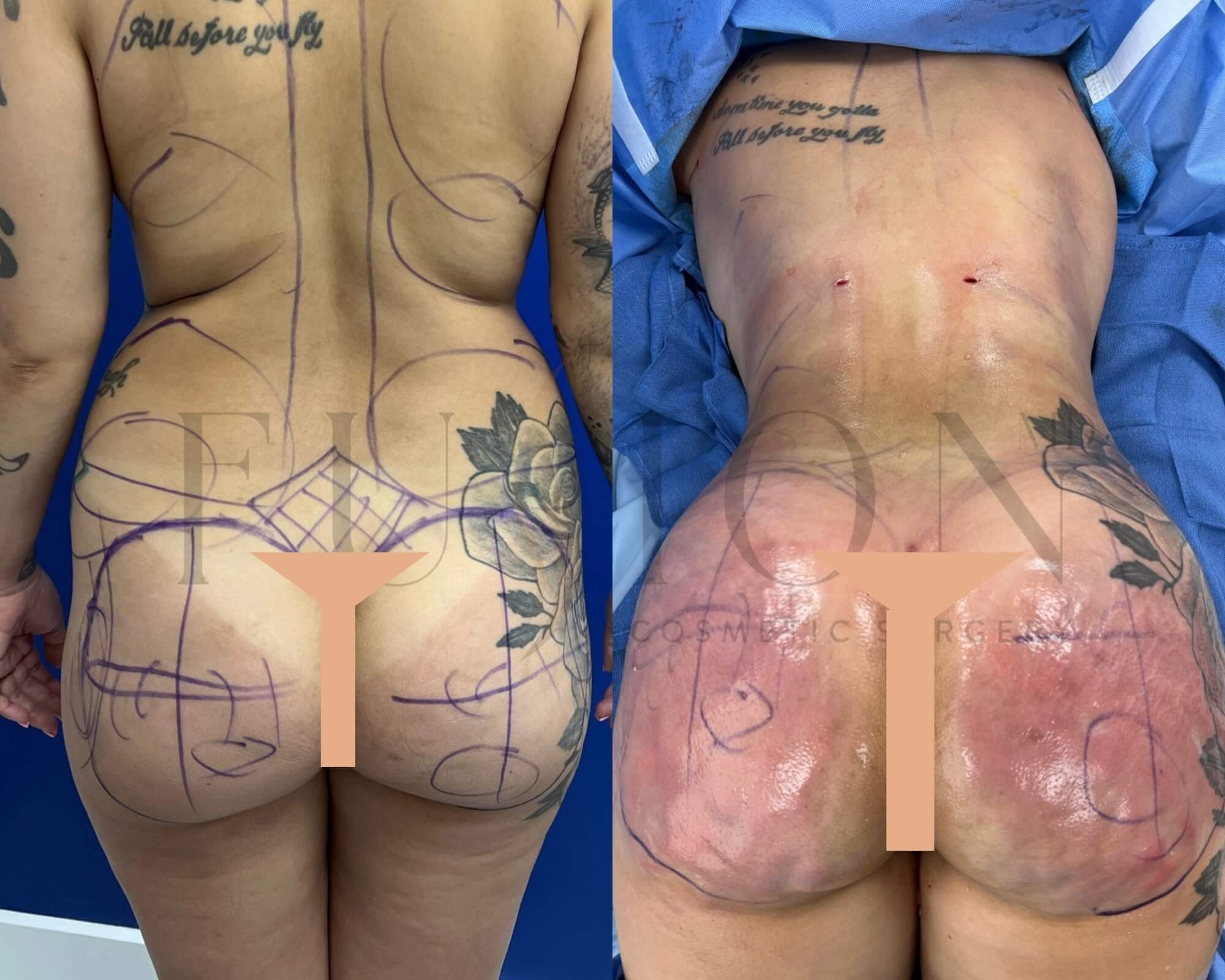 Liposuction and Fat Transfer Before & After Image