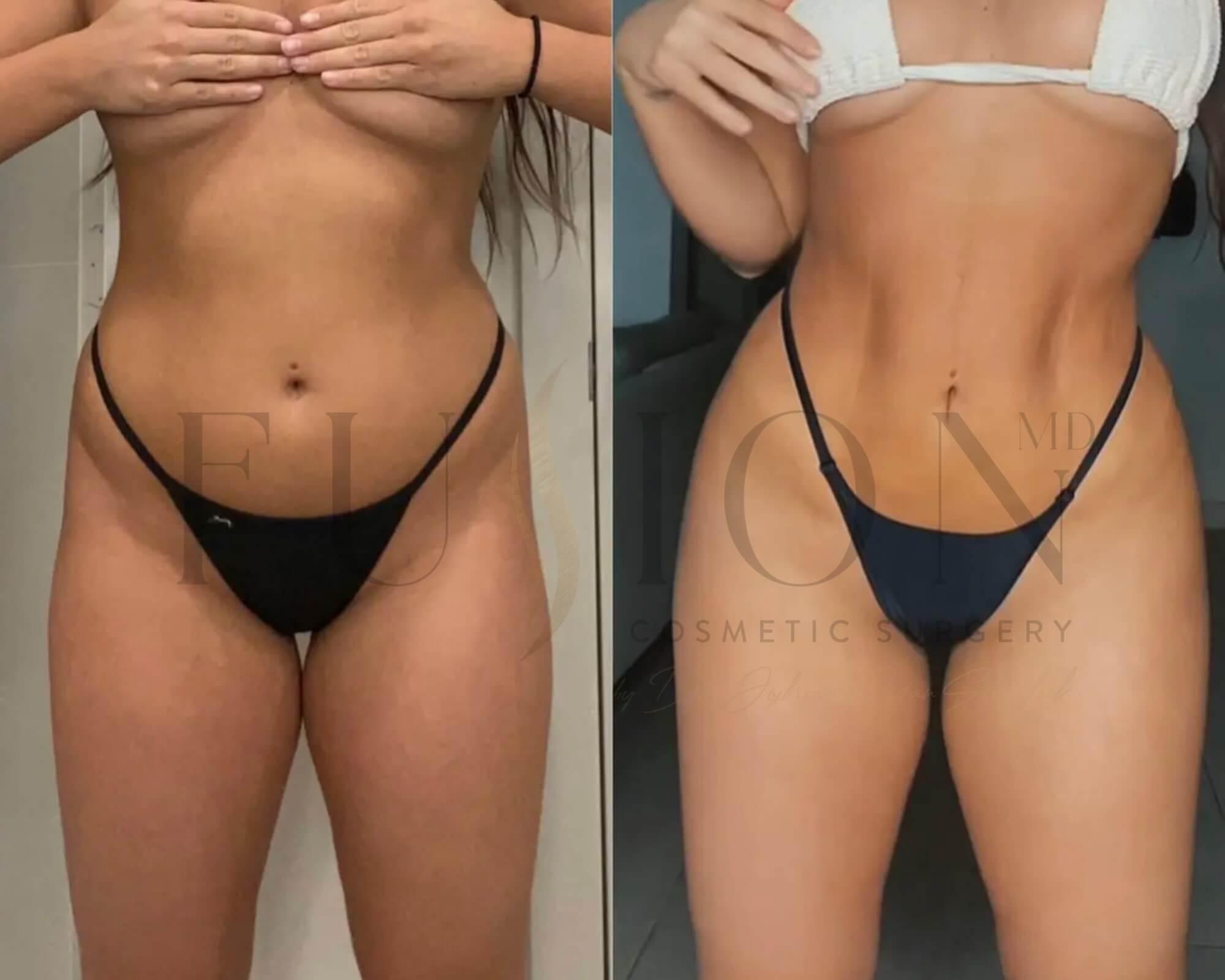 Liposuction and Fat Transfer Before & After Image