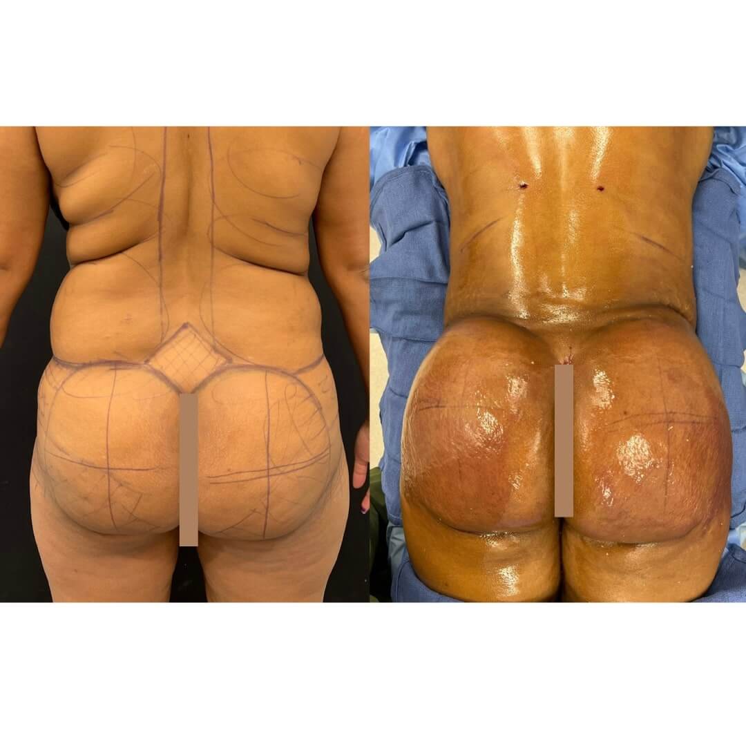 Liposuction and Fat Transfer Before & After Image