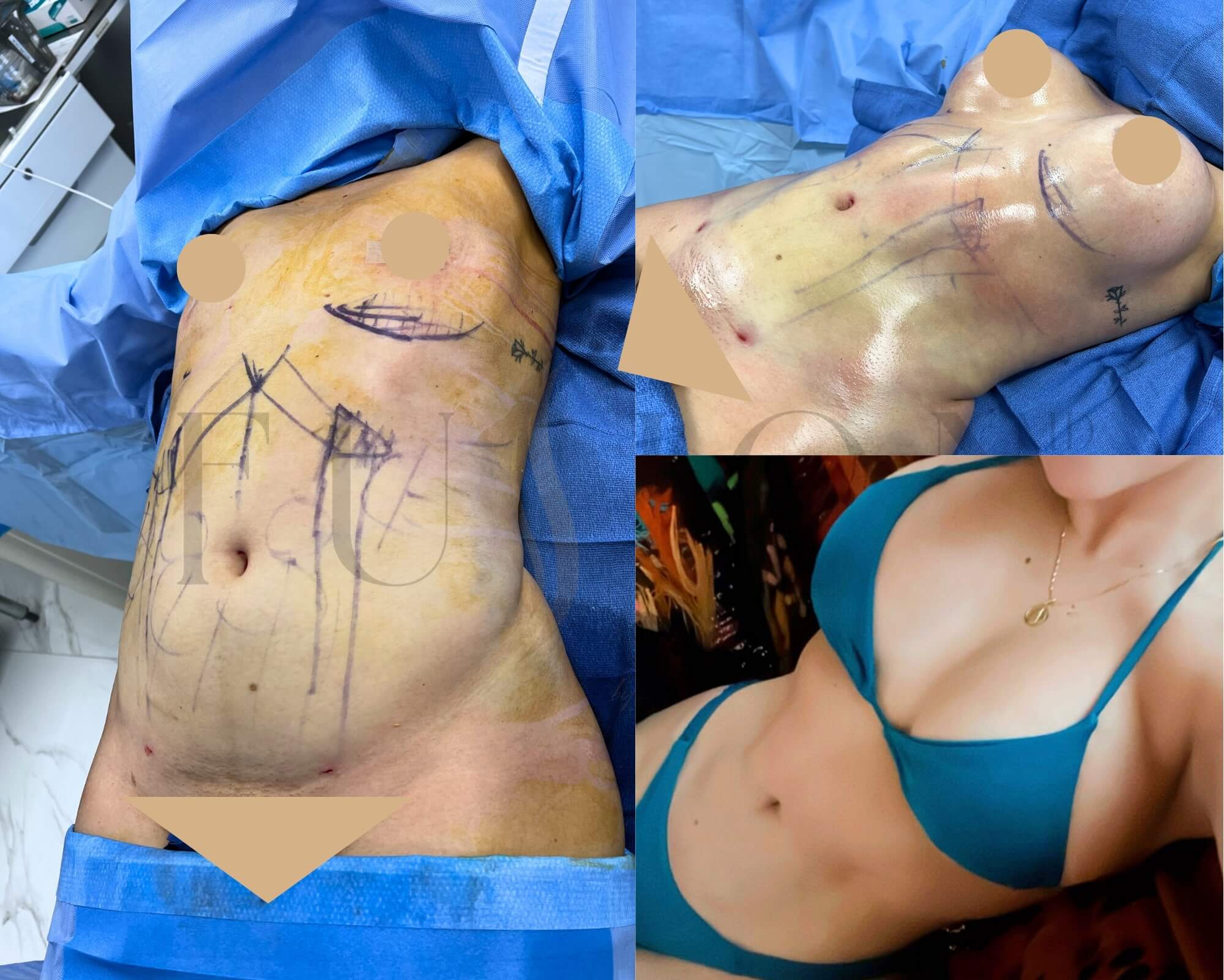 Mommy Makeover Before & After Image