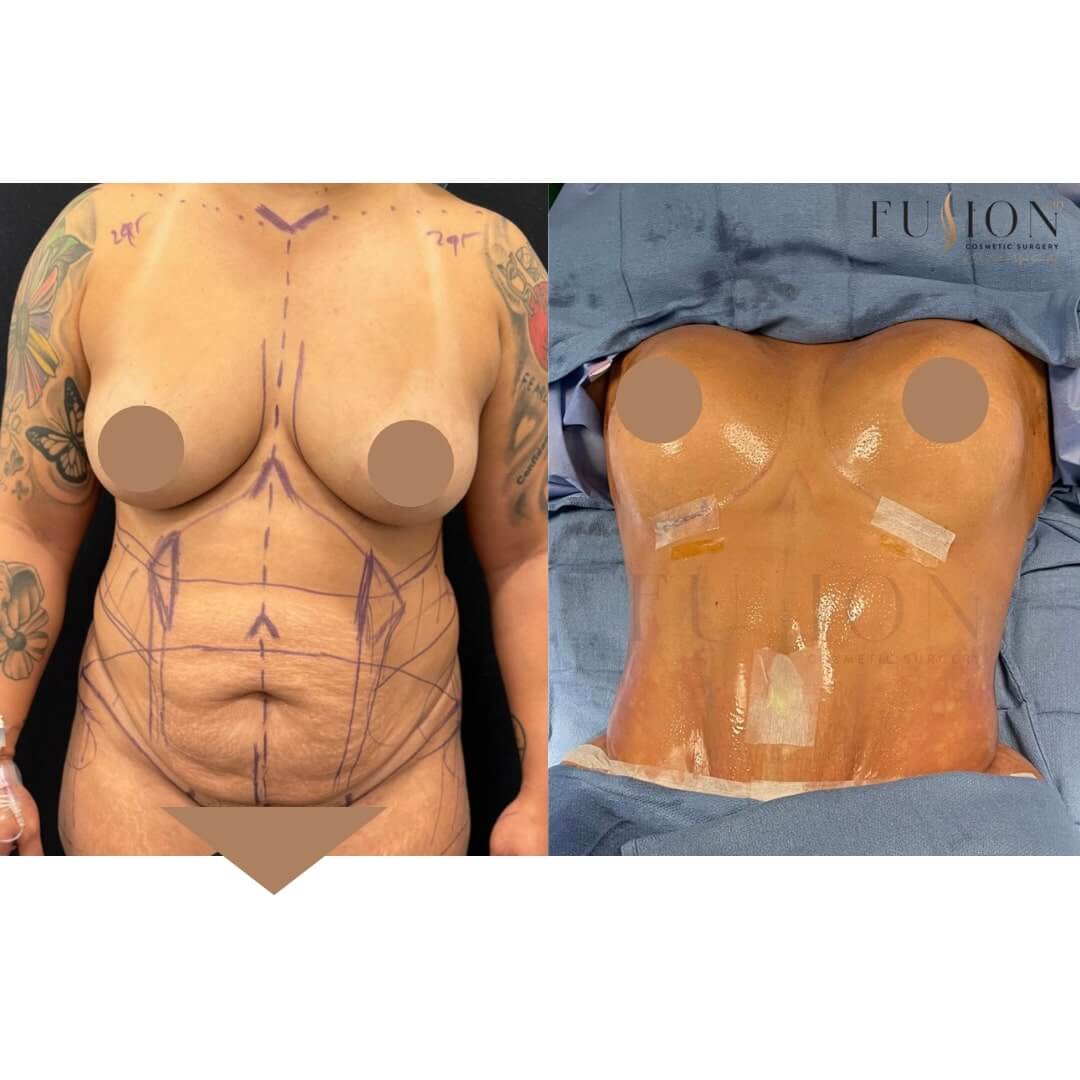 Mommy Makeover Before & After Image