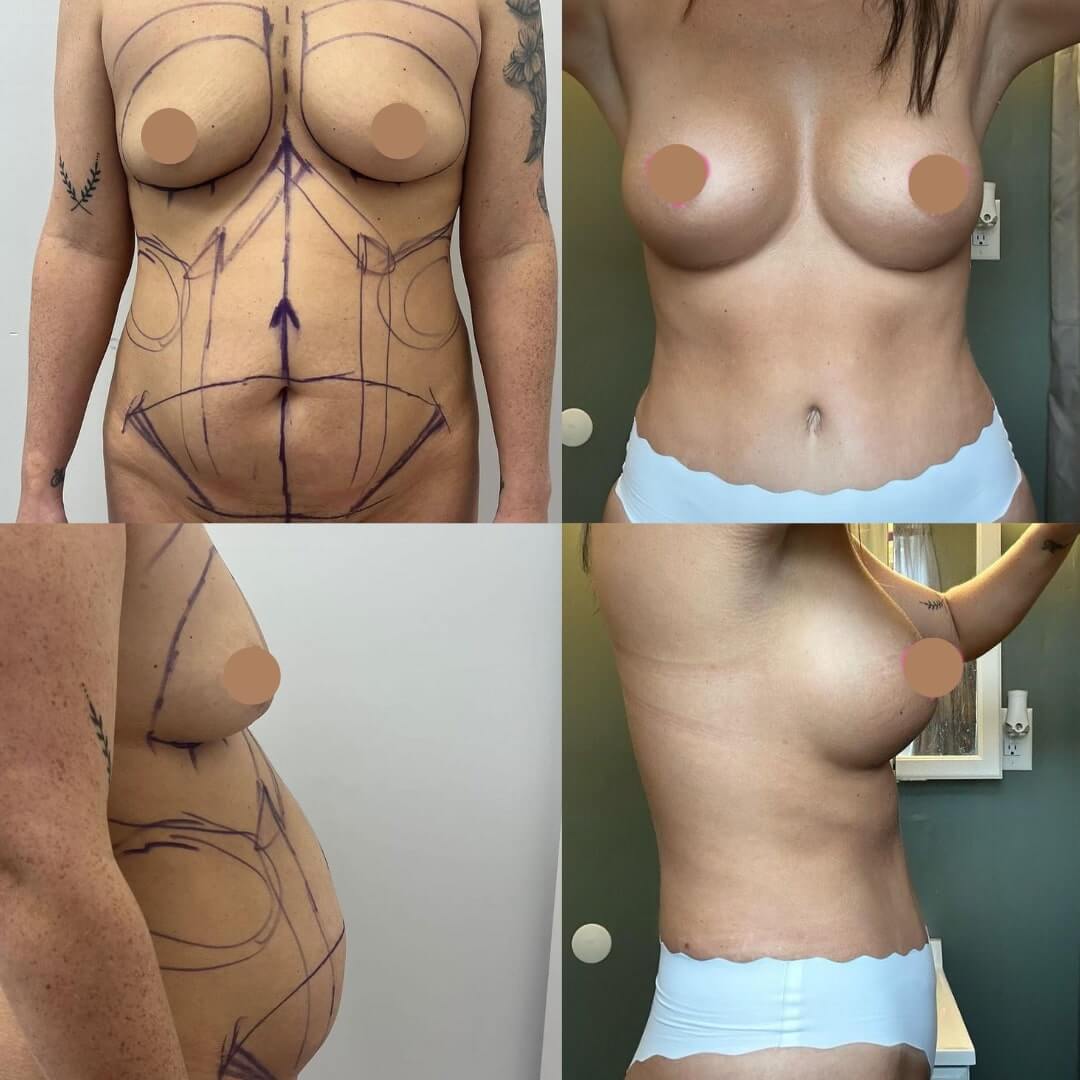 Mommy Makeover Before & After Image