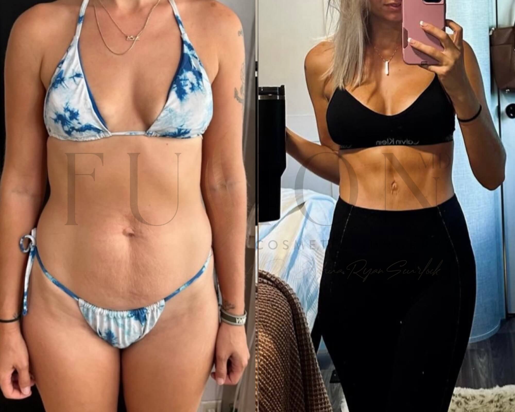 Mommy Makeover Before & After Image