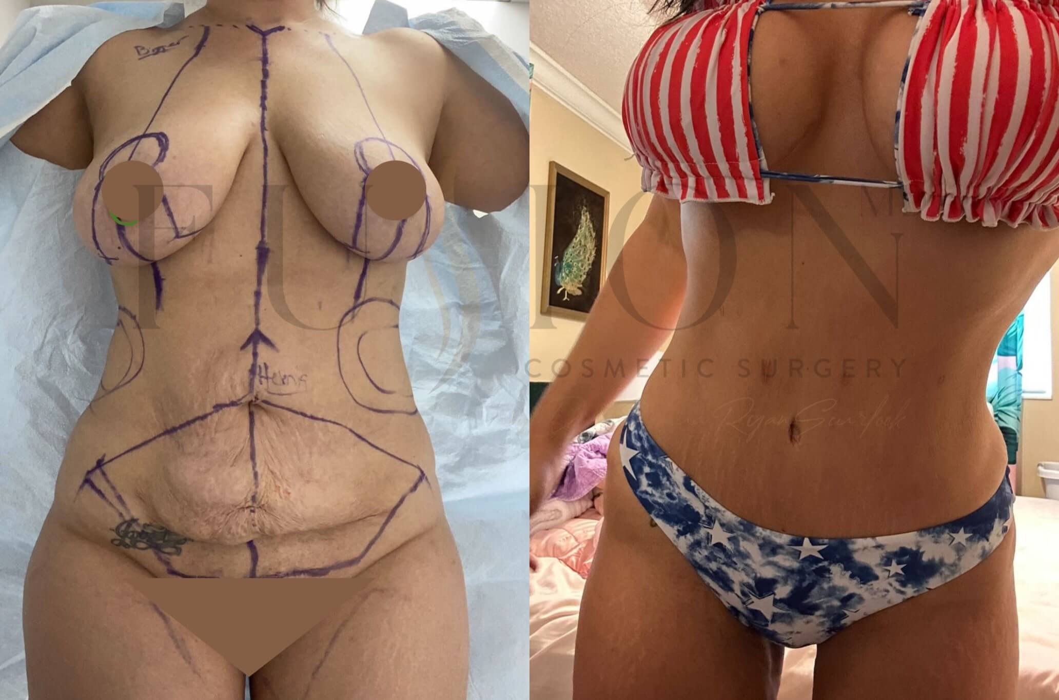 Mommy Makeover Before & After Image