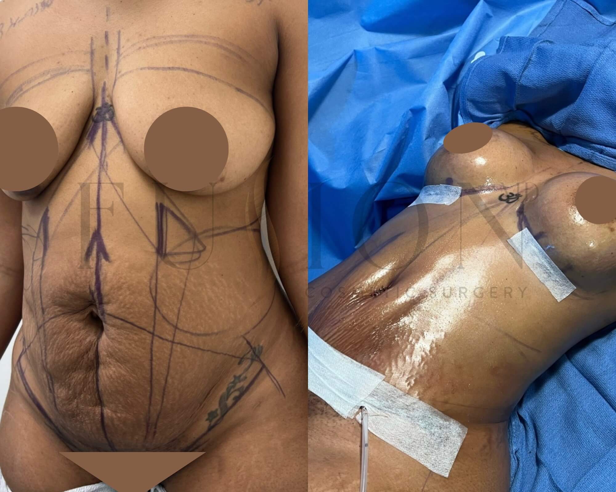 Mommy Makeover Before & After Image