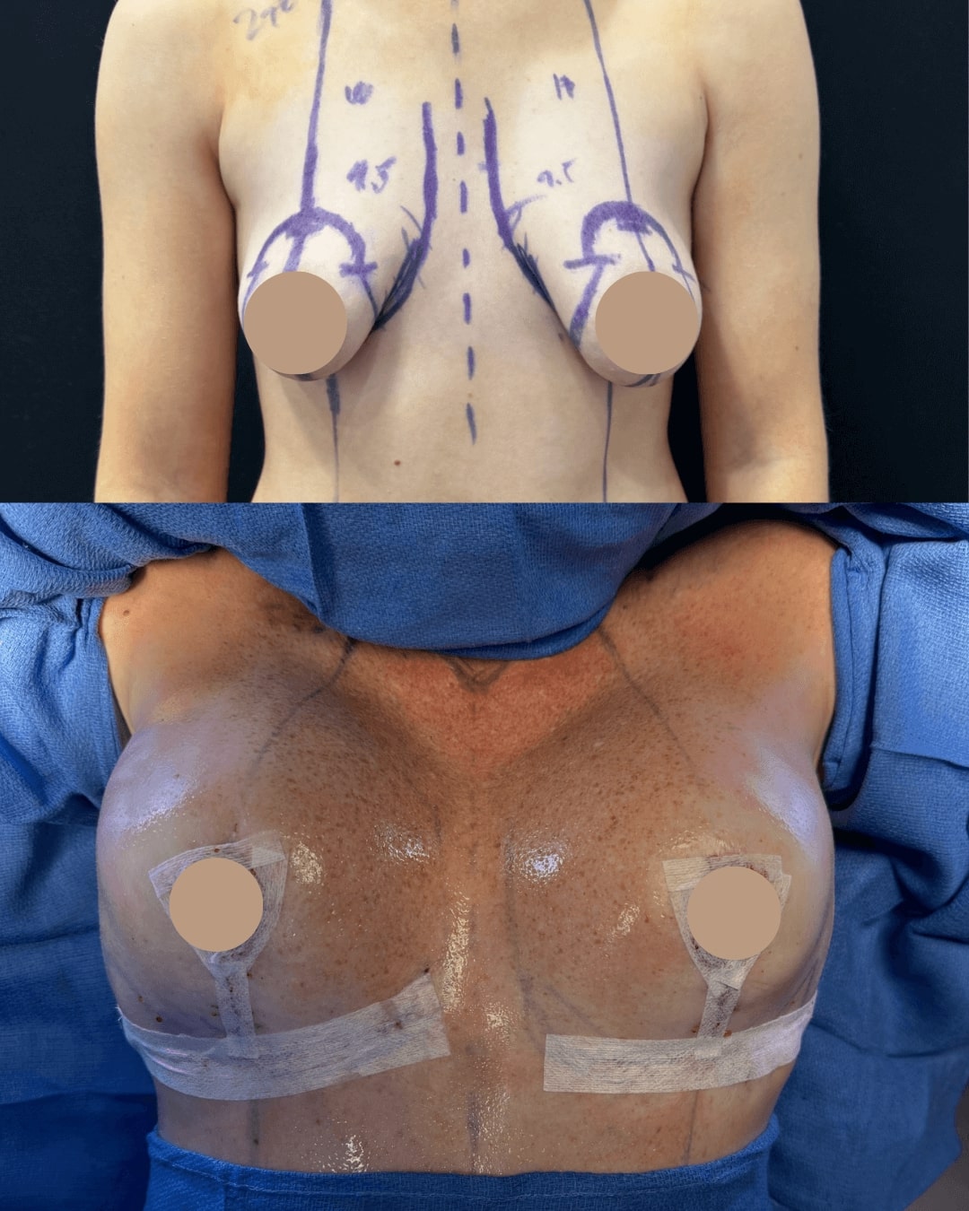 Breast Augmentation and Lift Before & After Image
