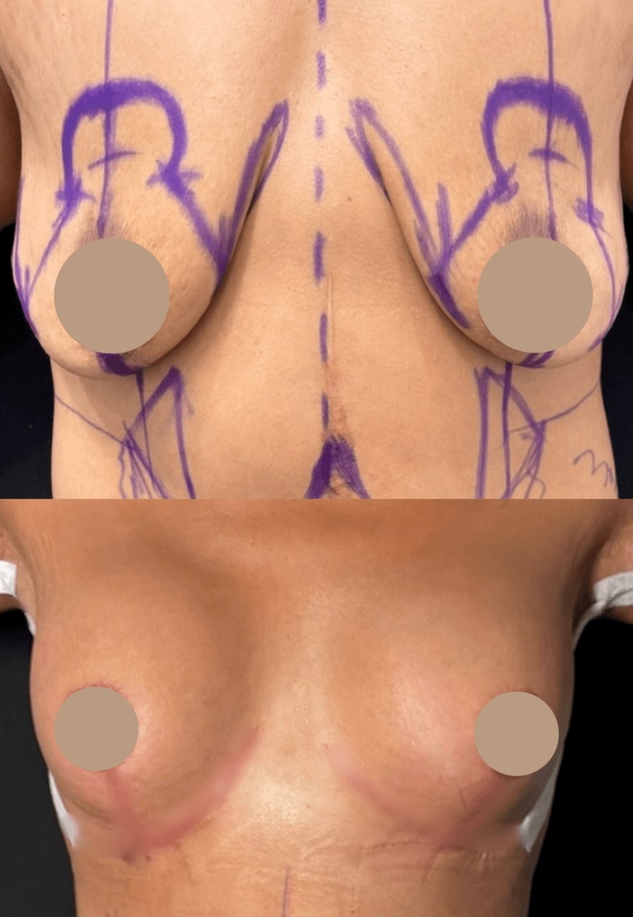 Breast Augmentation and Lift Before & After Image