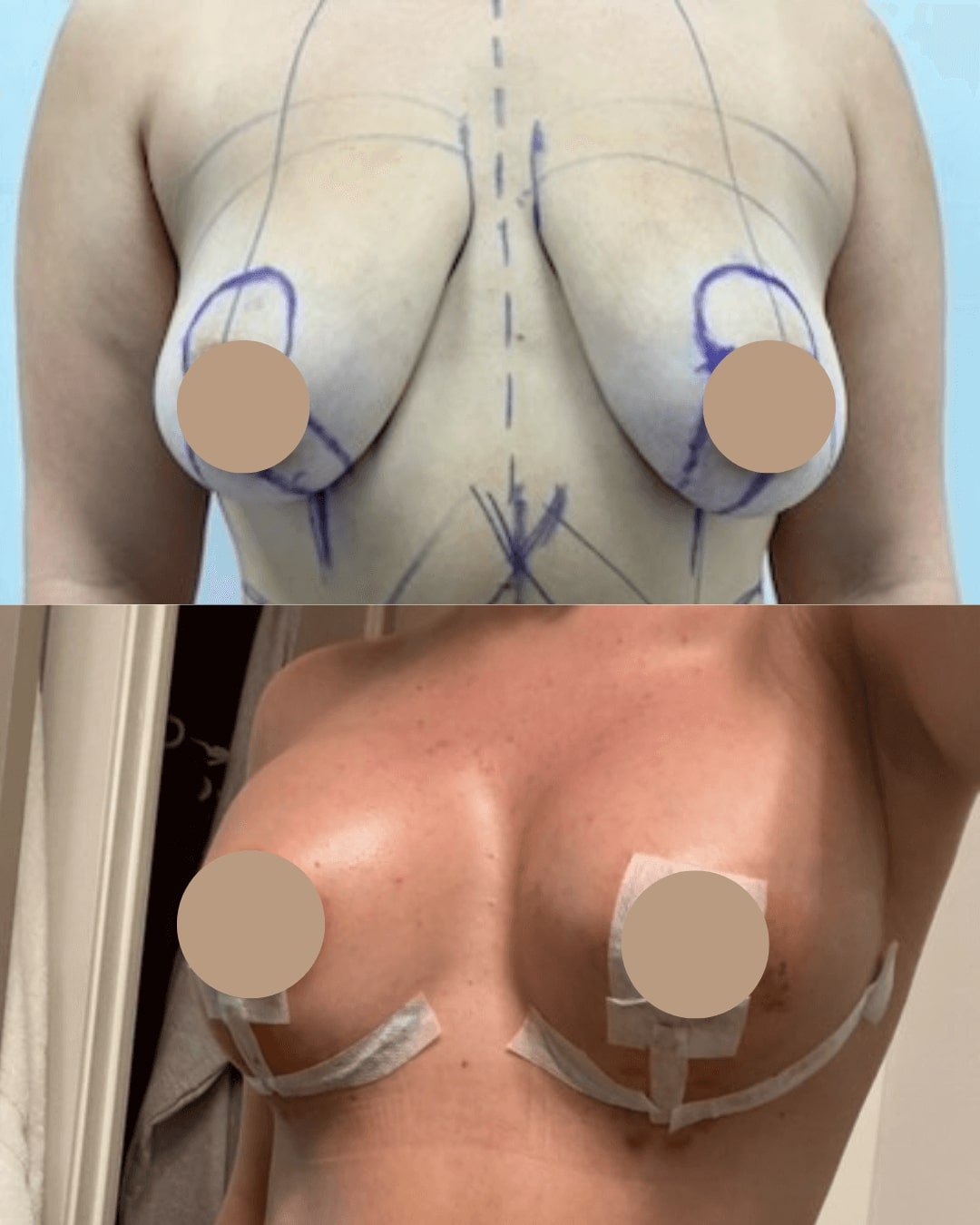 Breast Augmentation and Lift Before & After Image