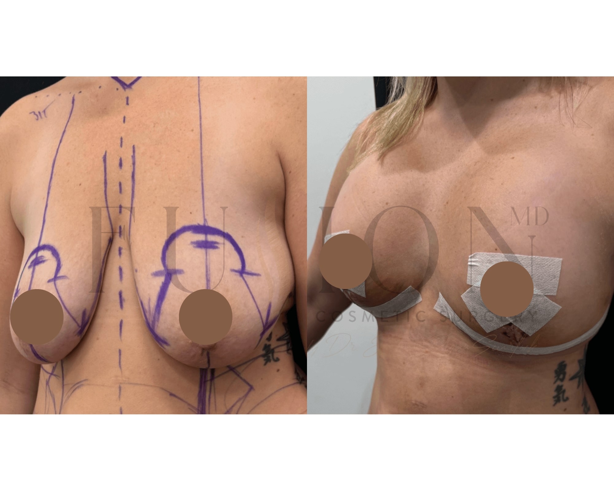 Breast Augmentation and Lift Before & After Image