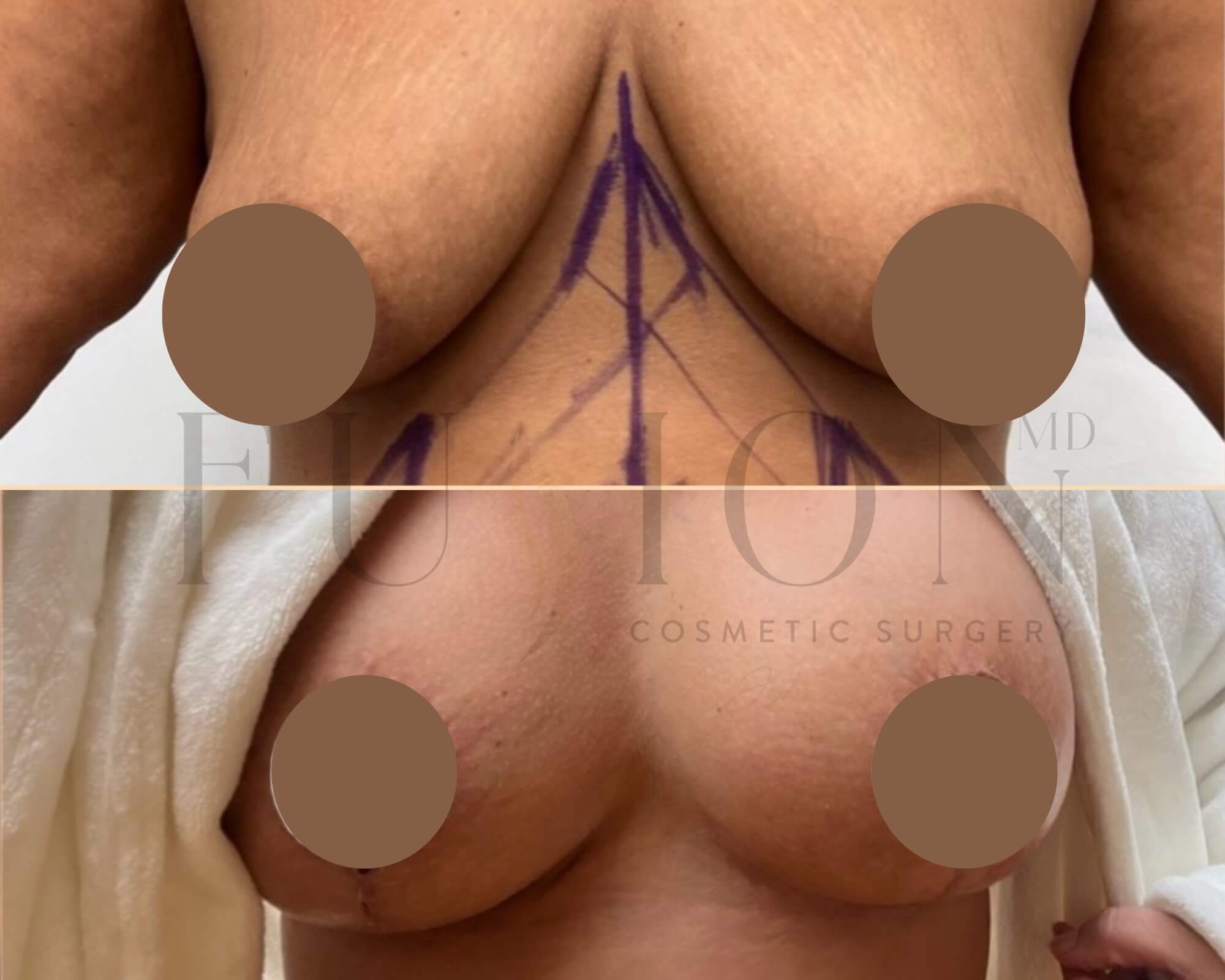 Breast Augmentation and Lift Before & After Image