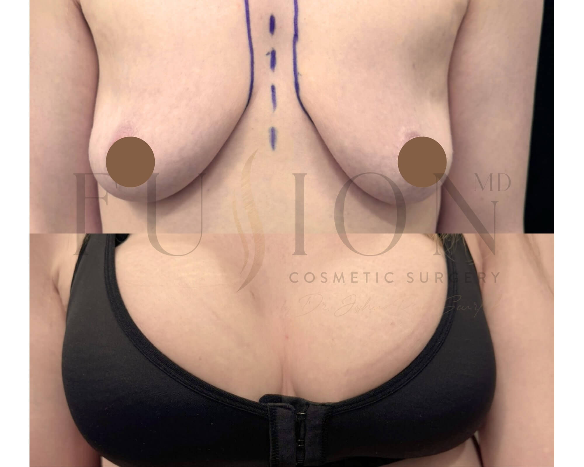 Breast Augmentation Before & After Image