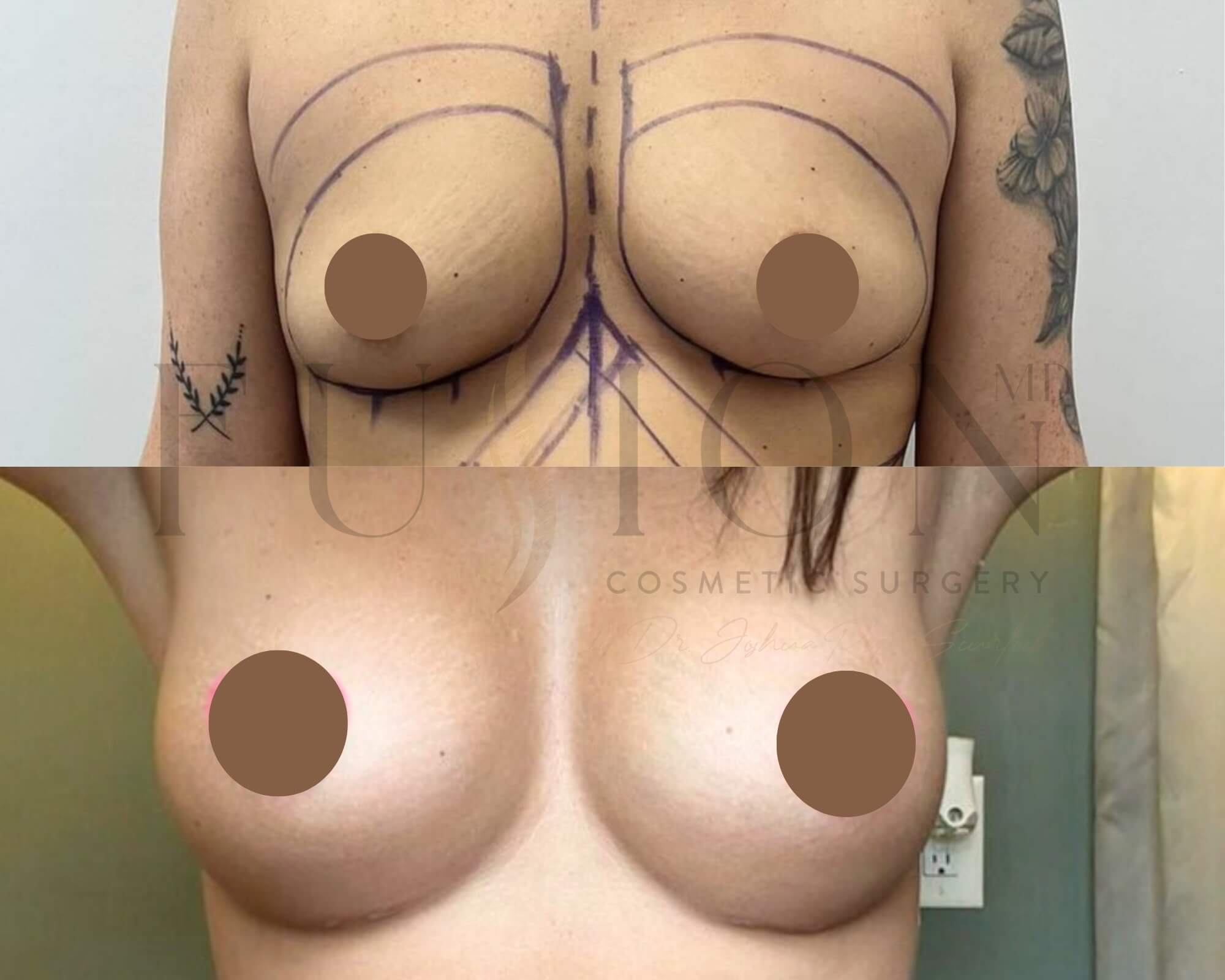 Breast Augmentation Before & After Image