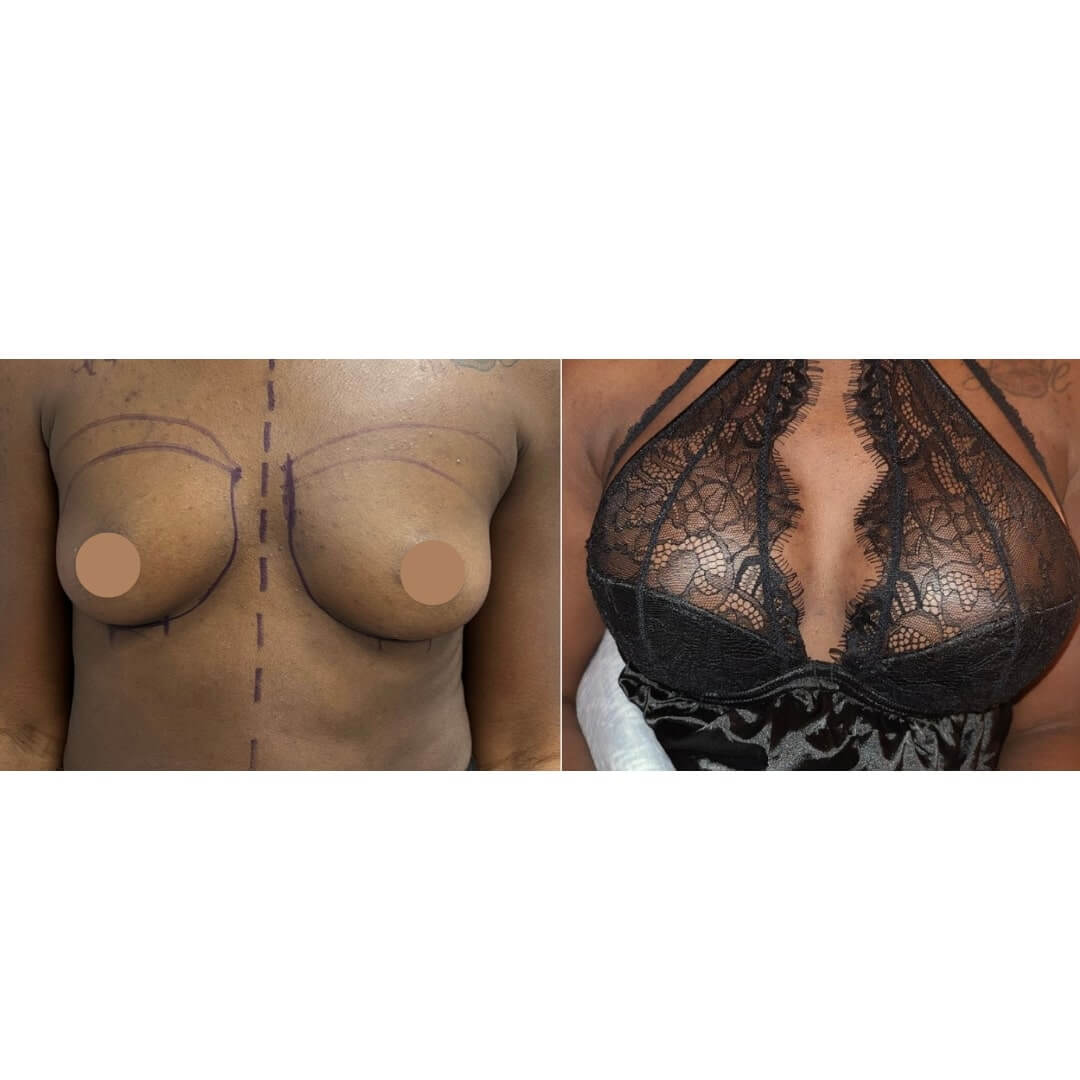 Breast Augmentation Before & After Image