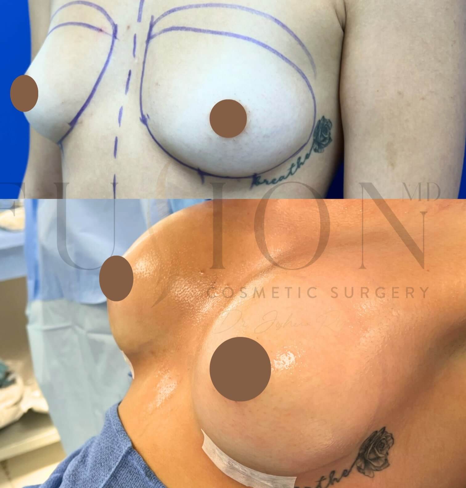 Breast Augmentation Before & After Image
