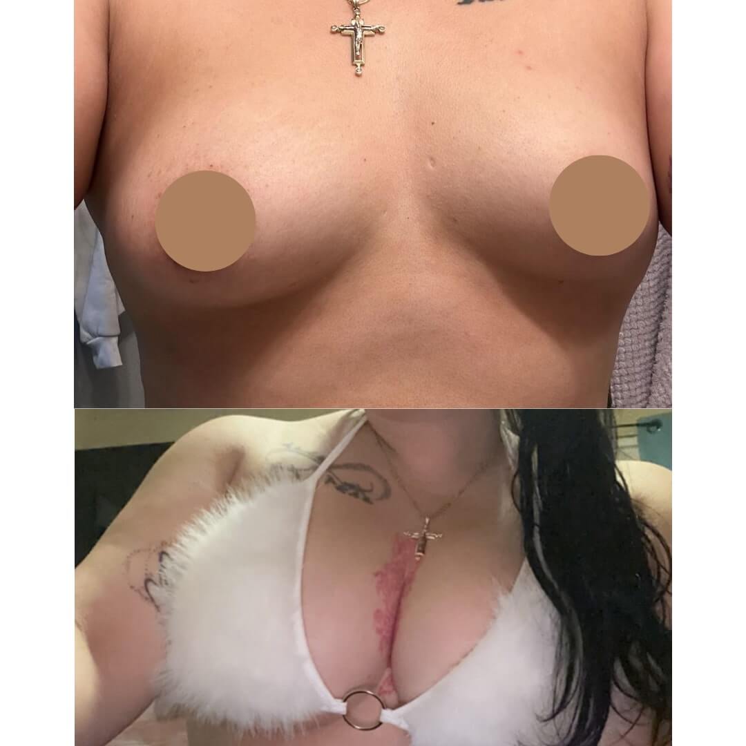 Breast Augmentation Before & After Image