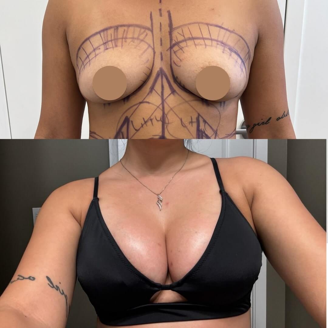 Breast Augmentation Before & After Image