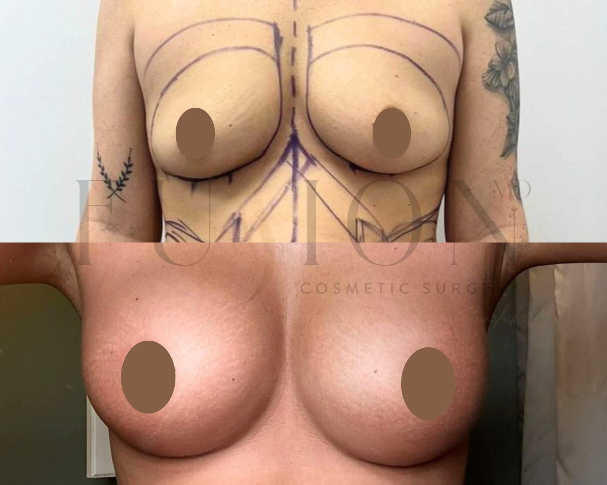 Breast Augmentation Before & After Image