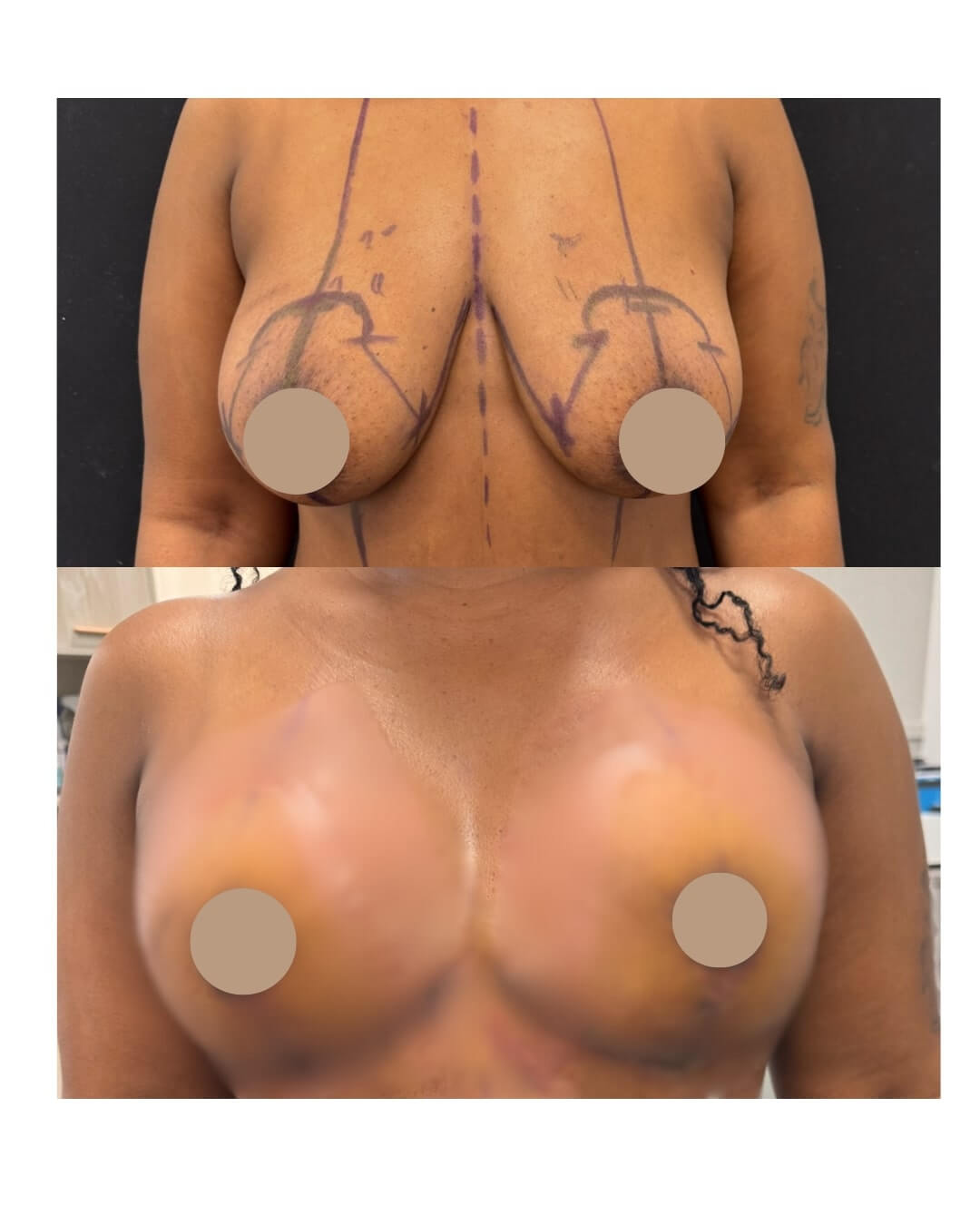 Breast Lift Before & After Image