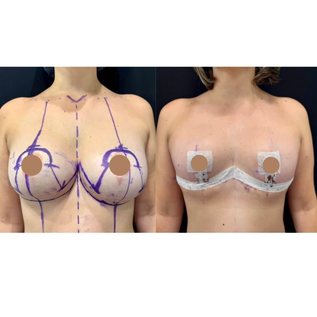 Breast Lift Before & After Image
