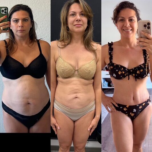 Curvy Tuck Spotlight Patient Spotlight Image