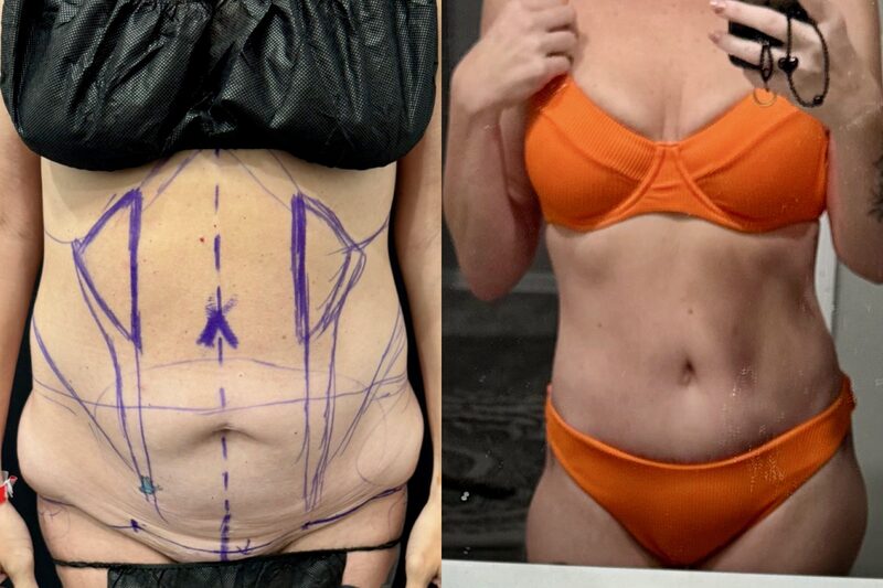 Curvy Tuck Spotlight Patient Spotlight Image
