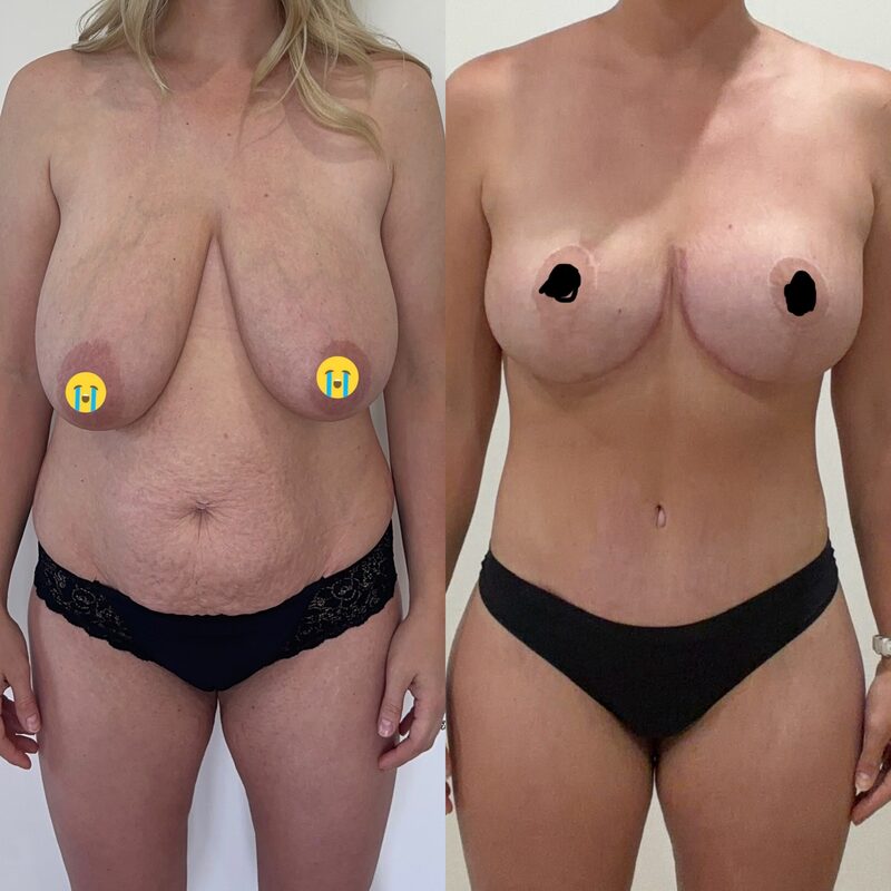 Curvy Tuck Spotlight Patient Spotlight Image