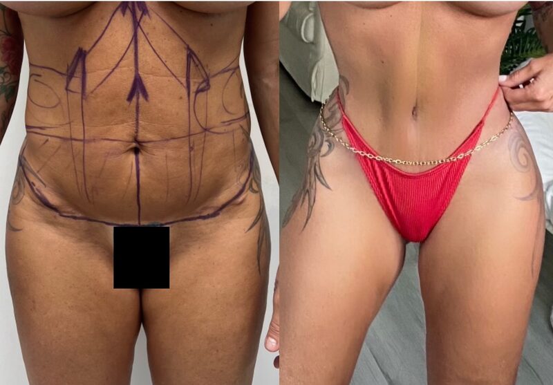 Curvy Tuck Spotlight Patient Spotlight Image