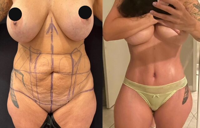 Curvy Tuck Spotlight Patient Spotlight Image
