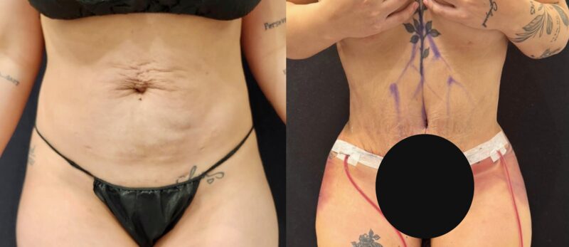 Curvy Tuck Spotlight Patient Spotlight Image